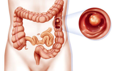 O que são os pólipos intestinais?