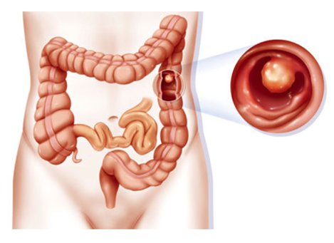 pólipos no intestino
