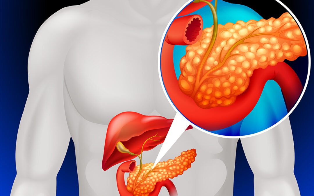 Cancer De Pancreas Sintomas Y Signos