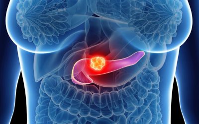 Câncer de pâncreas: tempo é tratamento — por que agir cedo e com uma equipe especializada